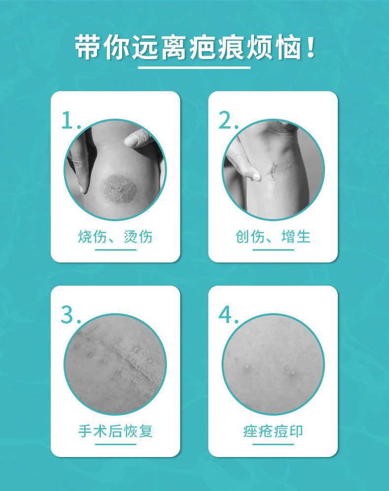 硅酮祛疤凝胶工厂 痤疮修护烧伤烫伤淡疤软化疤痕手术后恢复创伤愈合增生祛疤膏OEM 硅酮祛疤凝胶工厂 痤疮修护烧伤烫伤淡疤软化疤痕手术后恢复创伤愈合增生祛疤膏OEM